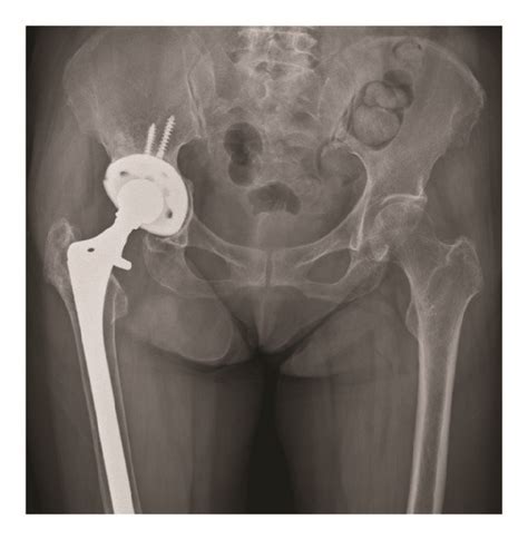 A Year Old Female Patient With Aseptic Loosening Of Right Bipolar