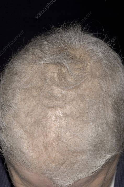 Hair Regrowth After Chemotherapy Stock Image M710 0121 Science Photo Library