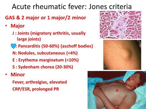 Jones Criteria For Rheumatic Fever Eduardotarogarcia