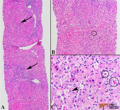 The Liver Biopsy Importance And Interpretation Aasld