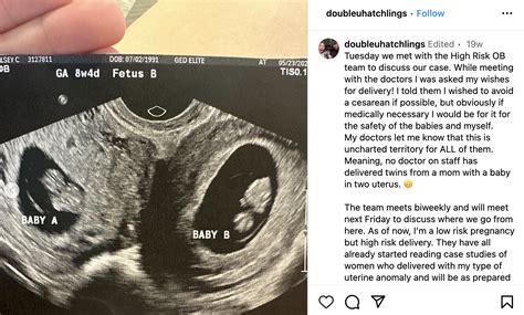 In Million Chance Us Woman With Rare Double Uterus Is Pregnant In