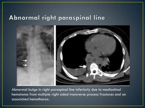 Ppt Imaging Anatomy Of The Mediastinum Powerpoint Presentation Free Download Id2075433