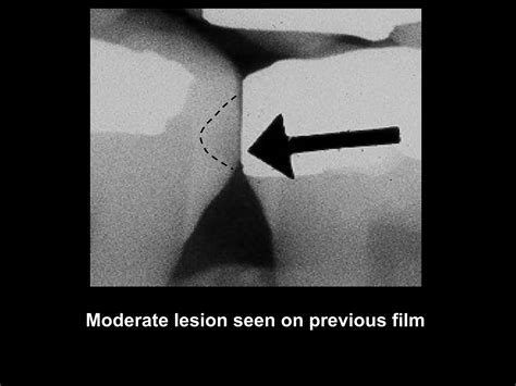 Radiographic Caries Diagnosis Ppt