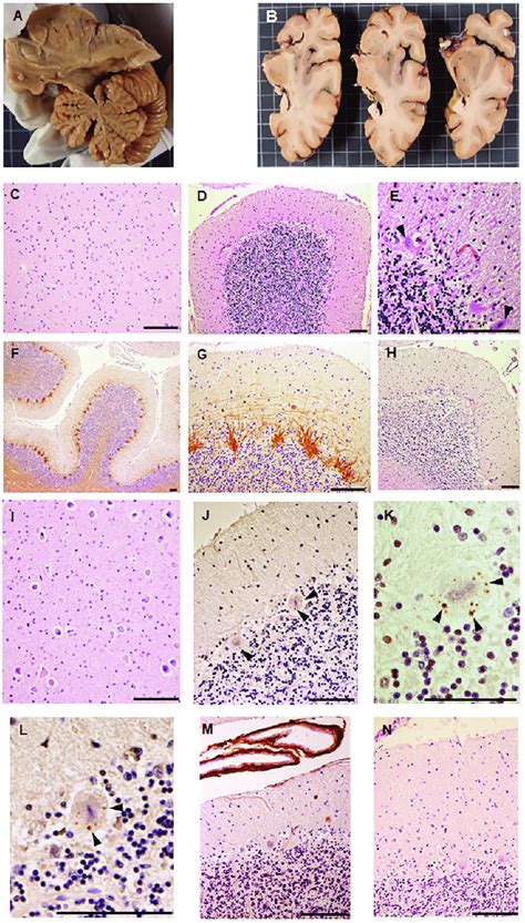 Neuropathological Alterations In SCA37 Pathological Lesions In