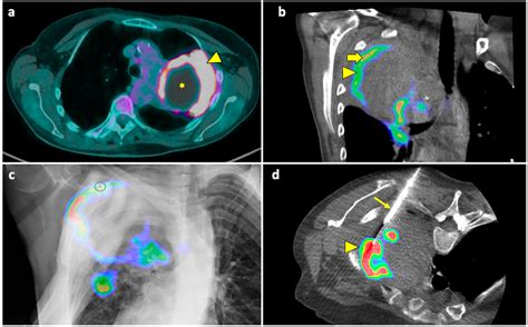 Diagnostics Free Full Text Computed Tomography Guided Lung Biopsy