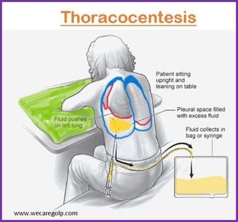 Thoracocentesis Pleural Tappleural Fluid Aspiration We Care