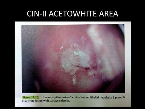 Cervical Intraepithelial Neoplasia Ppt