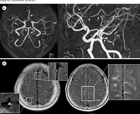 Figure 1 From Reversible Cerebral Vasoconstriction Syndrome Presenting As Transient Vessel Wall