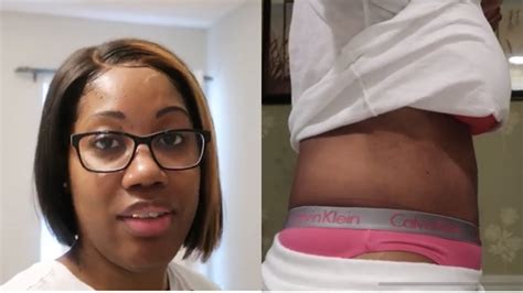 5 Weeks Tummy Tuck Post Op Before And After Photos Youtube