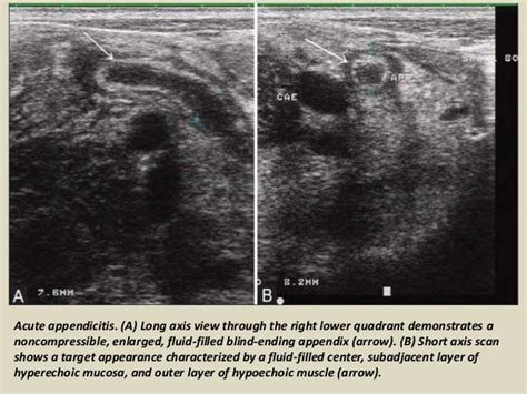 Appendix Landmarks Ultrasound