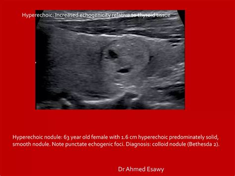 Tirads Thyroid Nodule Imaging Reporting And Data System Dr Ahmed