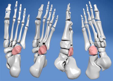 Cuboid Syndrome - Paragon Orthotic Laboratory