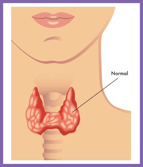 Thyroidectomy & Thyroid Lobectomy Surgery Johannesburg