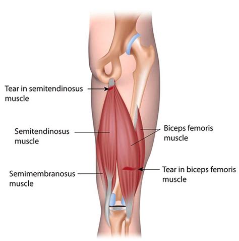 Pulled hamstring cause and treatment with 3 relief exercises