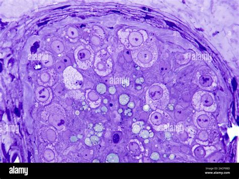 Testicular Cancer Light Micrograph Of A Section Through Part Of A