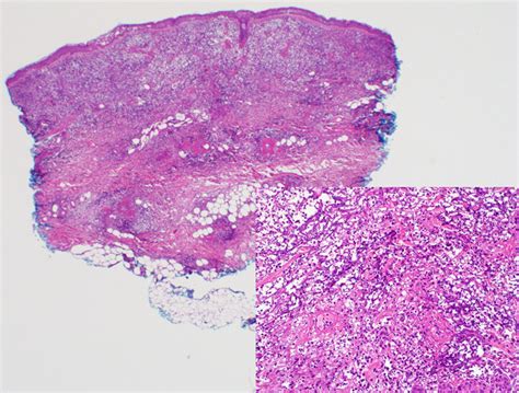 Skin Biopsy From The Arm With A Dense Dermal Neutrophilic Infiltrate