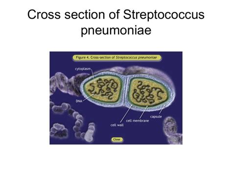 bacterial pneumonia