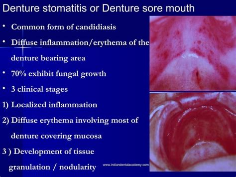 Candidiasis Cosmetic Dentistry Courses