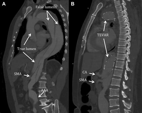 A Computed Tomography Ct Angiography Showing A Complex Type B Aortic