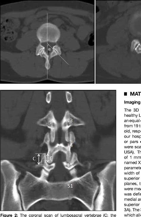 Figure From Transforaminal Lumbar Interbody Fusion With Unilateral