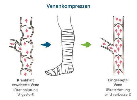 schlucken Befehl Peave thromboseprophylaxe übungen im bett Unsicher