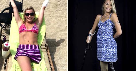 Aimee Copeland Flesh Eating Bacteria Survivor Shares Inspiring New