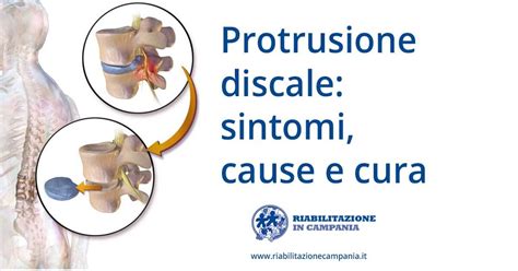 Protrusione Discale Sintomi Cause E Cura Riabilitazione In Campania