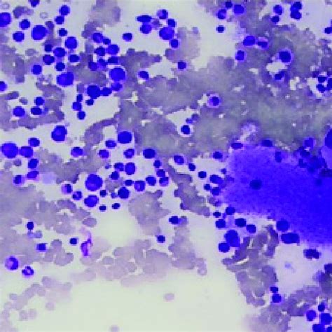 Bone Marrow Aspirate Showing Plentiful Megakaryocytes And Increased