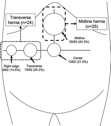 Classification Of Incisional Hernia Sites Incisional Hernias Accounted