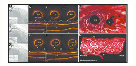 Bioresorbable Vascular Scaffold Implantation In A Thrombotic