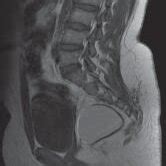 The Pelvic T Weighted Magnetic Resonance Imaging In The Sagittal Slice