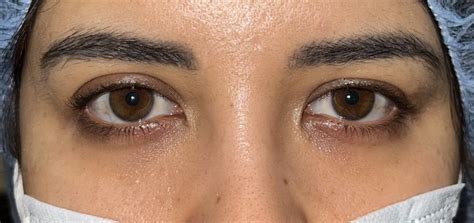 2 Upper Eyelid Surgery Before And After Photos Dallas Plano Texas Cosmetic Reconstructive