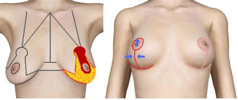 Lifting Seins Chirurgie Du Sein