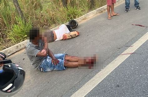 Motociclista Tem Parte Da Perna Amputada Em Acidente Na BR 104 Em