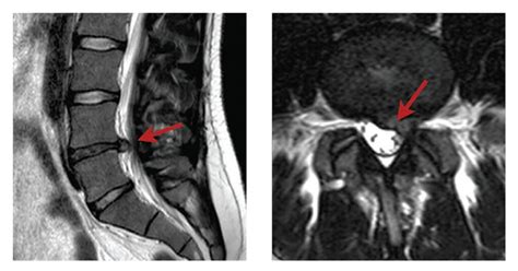 Understanding Lumbar Disc Prolapse And Lumbar Discectomy Spineplus