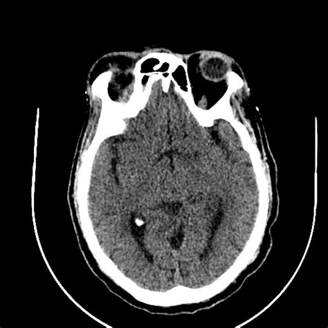 Chronic Invasive Fungal Sinusitis Image