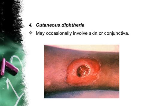 Diphtheria Dr Yusuf Imran