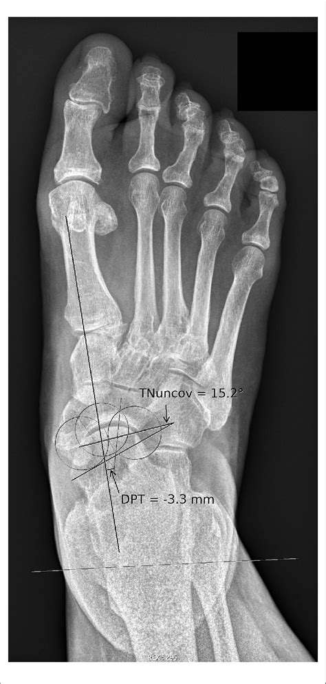 Dorsoplantar Radiograph Of A Foot With Exclusive Sagittal Plane