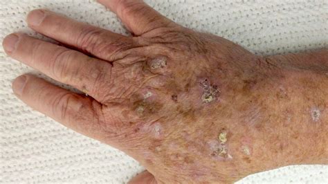 Pictures Of Squamous Cell Carcinoma And Symptoms