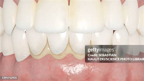 16 Teeth Calculus Stock Photos, High-Res Pictures, and Images - Getty ...