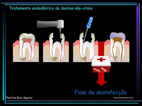 Pdf Patr Cia Ruiz Spyere Biopulpectomia Tratamento Endod Ntico De