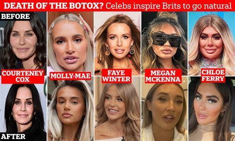 Celebrity Botox Before And After