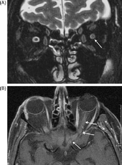 patient presenting  bitemporal hemianopia  major vision loss