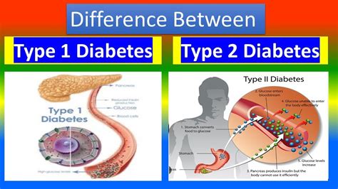 Distinction Between Type Diabetes And Type Diabetes Youtube