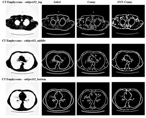 A comparison of edge detection by Sobel, Canny, and SNN Canny edge ...