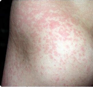 What Causes Red Itchy Bumps On The Skin? — Medipulse: Best Private ...