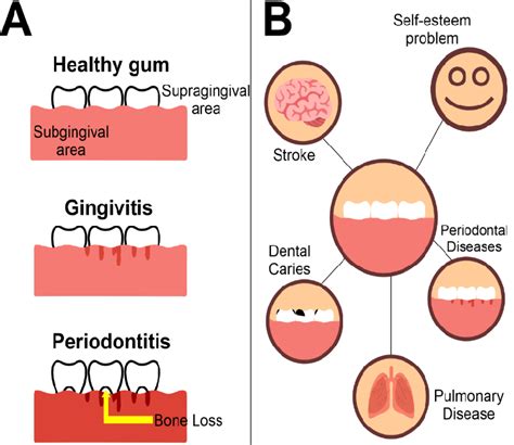 -General aspects of periodontal diseases | Download Scientific Diagram