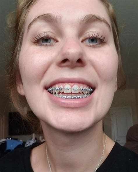 Braces Girlswithbraces Metalbraces Elastics Zahnspange Zähne