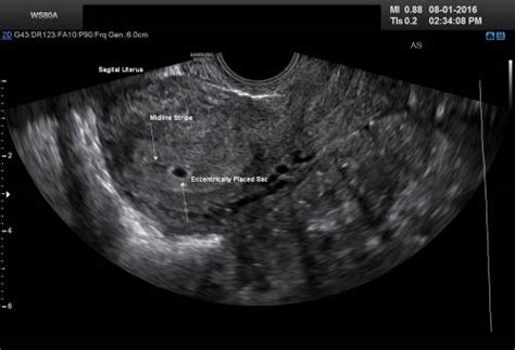 4 Weeks Pregnant Ultrasound: Pictures and Description | IYTmed.com