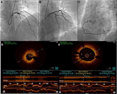 invasive evaluation  ica  oct   patient presented